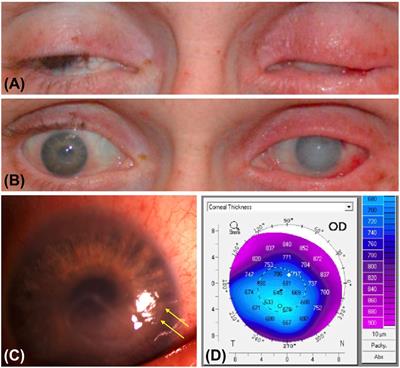 Frontiers Vision health perspectives on Breaking Bad Ophthalmic